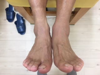 捻挫の施術事例