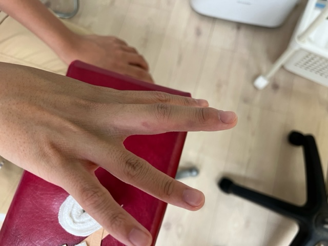 行徳 接骨院 突き指の症例